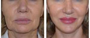 cellule-rigenerative-viso-lifting-edoscopico-domenico-miccolis