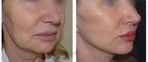 lifting-non-chirurgico-occhi-viso-foto-dottor-miccolis
