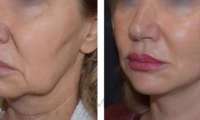 lipofilling-viso-costo-milano-lifting-verticale-facciale-miccolis