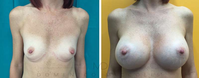 lipofilling seno prima e dopo miccolis