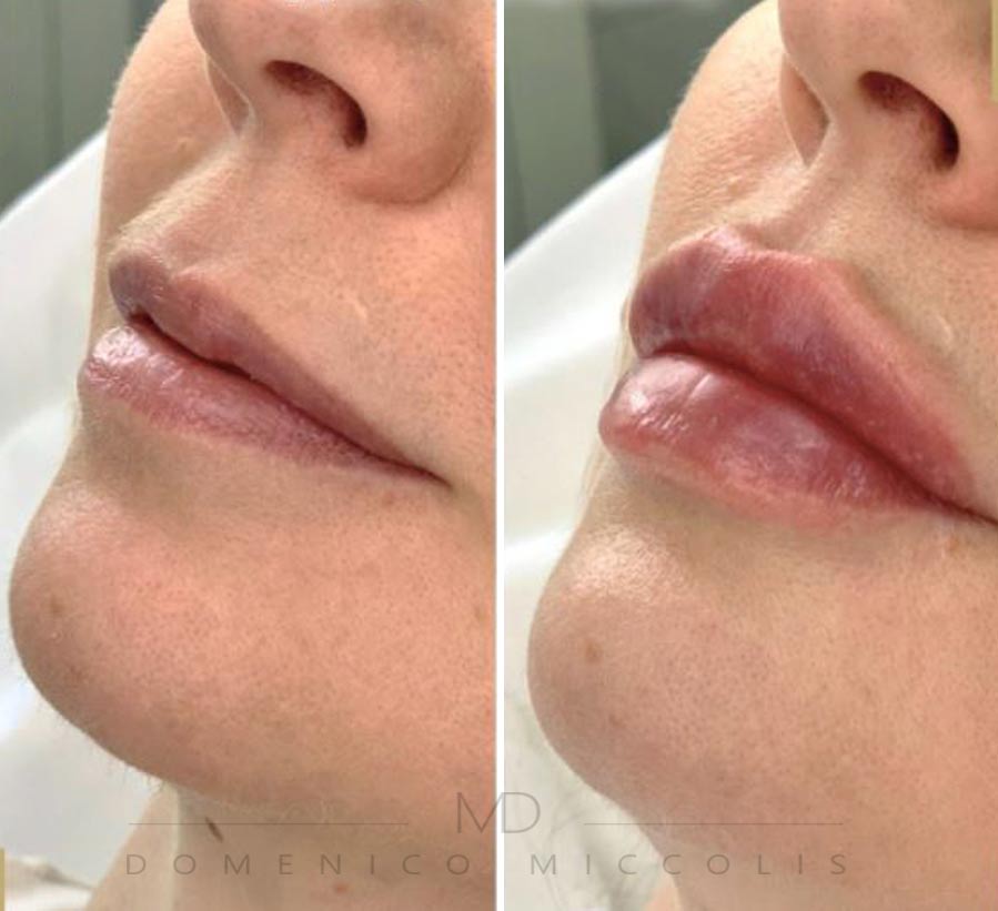 acido ialuronico labbra prima e dopo