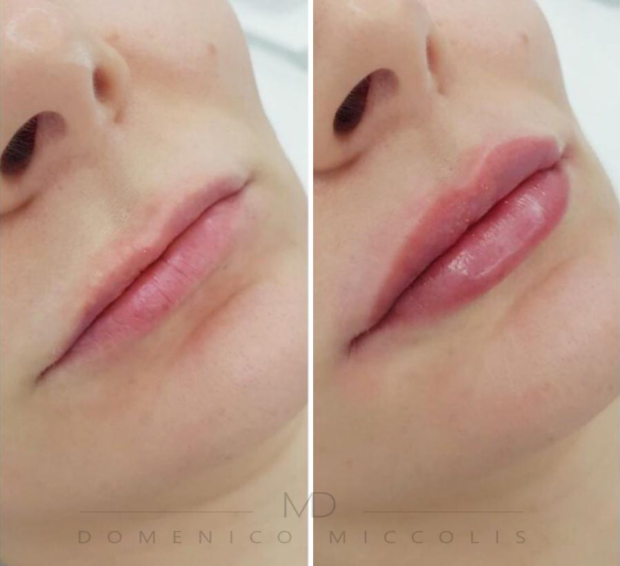 protesi labbra prima e dopo